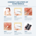JPNK Blackhead Remover Tool Comedones Extractor Acne Removal Kit for Blemish, Whitehead Popping, 6 Pcs Zit Removing for Nose Face Tools with a